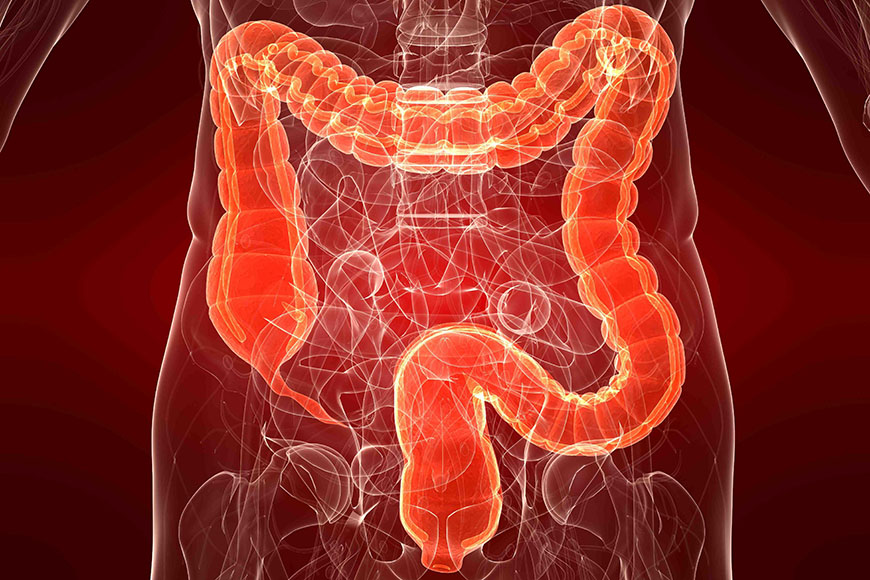 INTESTINO IRRITABILE E DISBIOSI