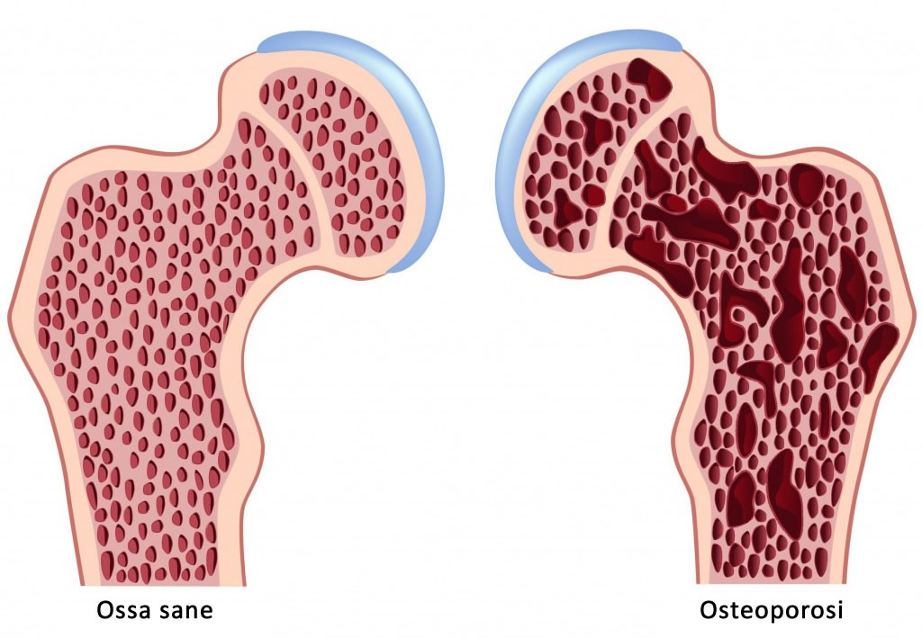 Osteoporosi