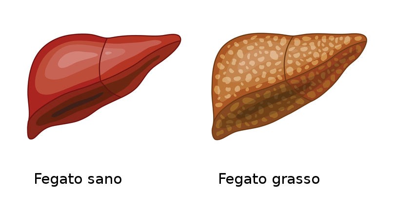 FEGATO GRASSO (STEATOSI): NON E’ COLPA DEI GRASSI